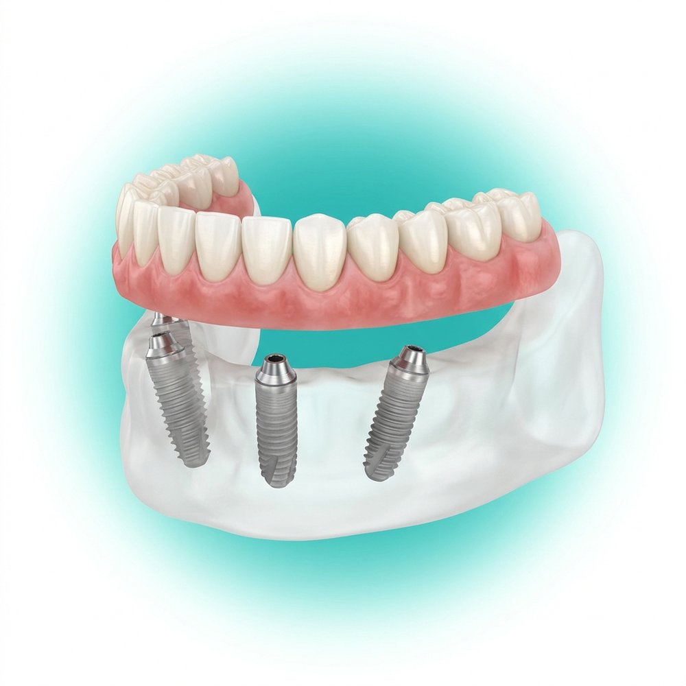 Modelo de arcada com prótese fixa apoiada em quatro implantes