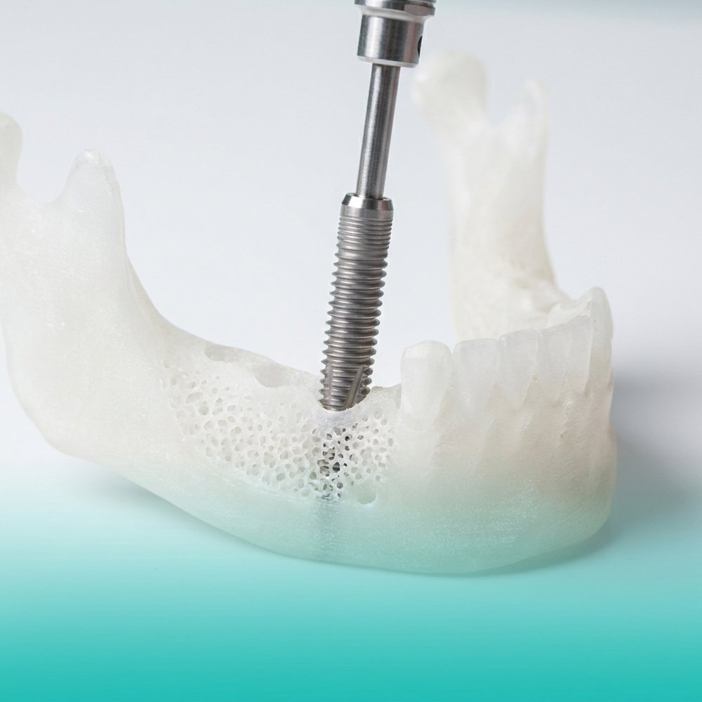 Implante dentário de titânio sendo posicionado em modelo anatômico de mandíbula