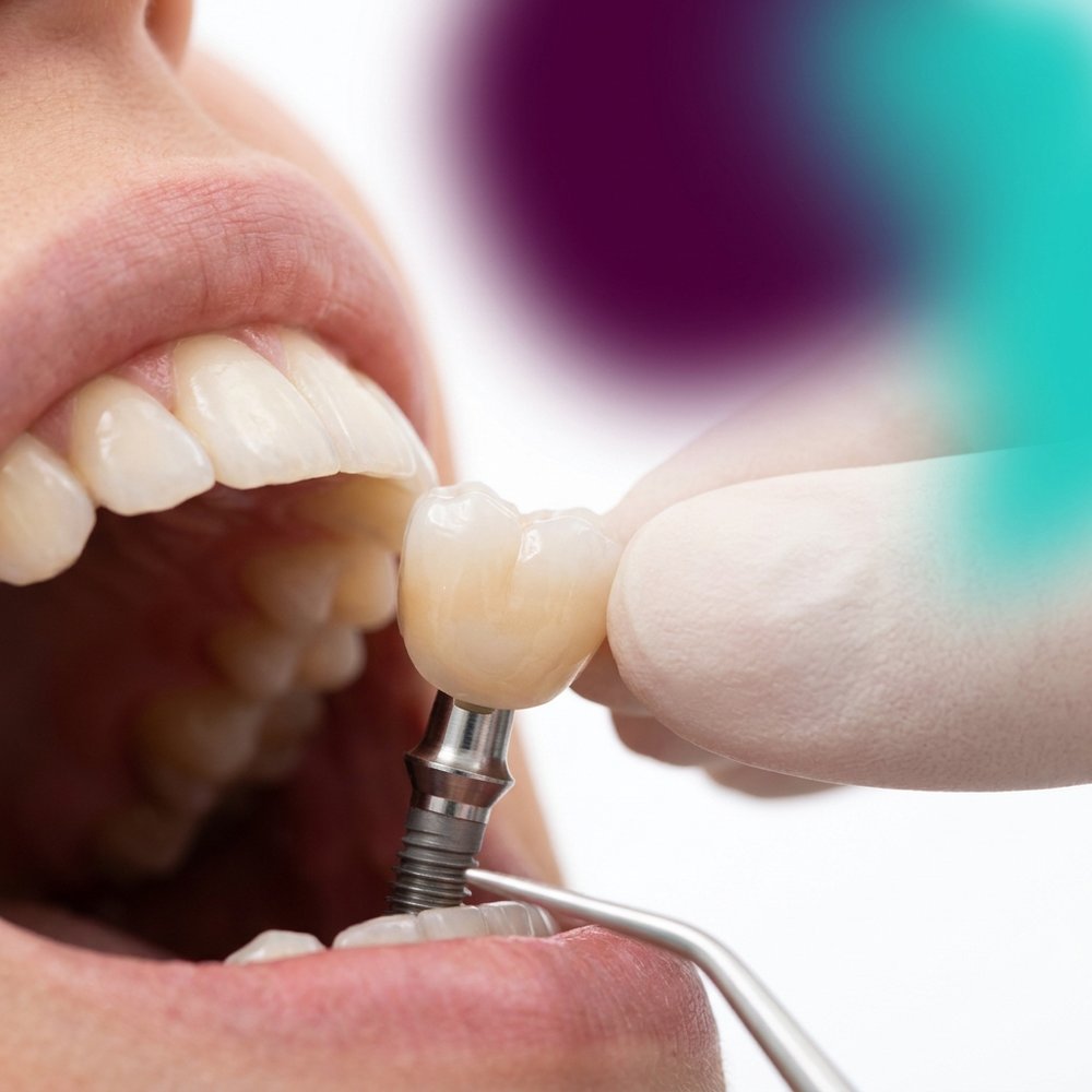 Coroa protética sendo posicionada sobre implante em modelo dentário